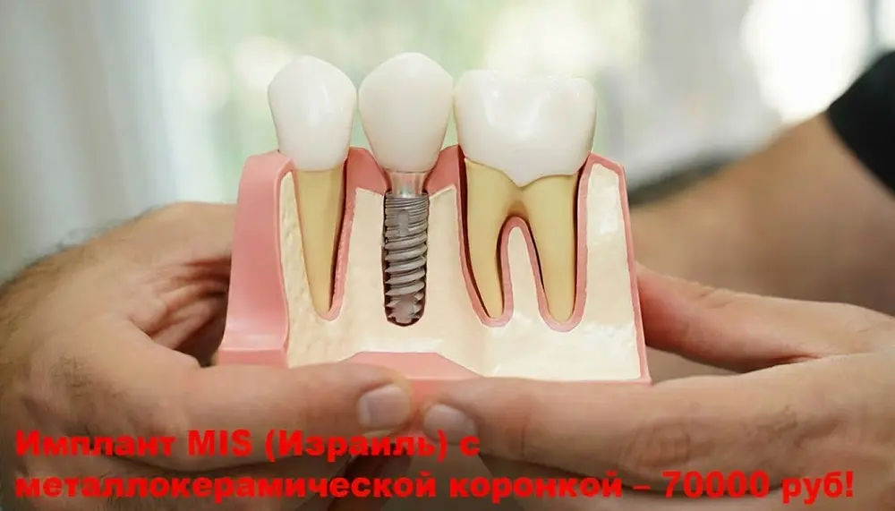 Имплант MIS (Израиль) c коронкой — 70 000 руб!