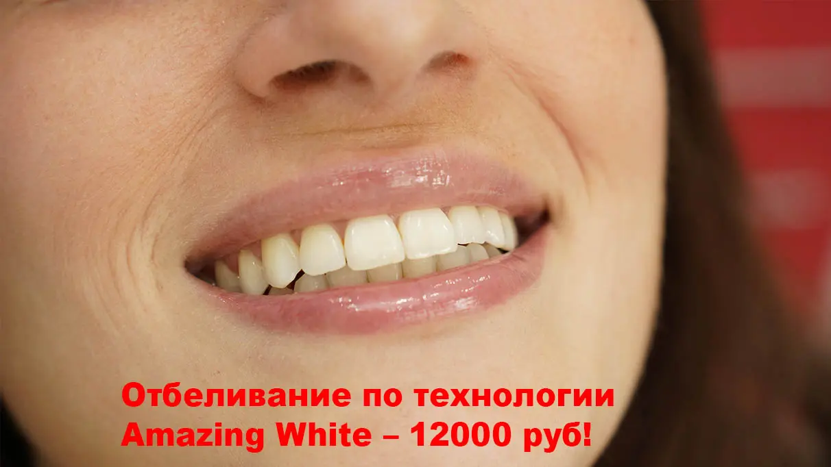 Отбеливание Amazing White — 12 000 руб!